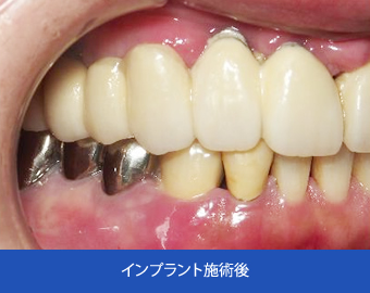 インプラント施術後