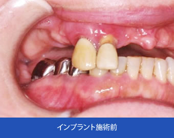 インプラント施術前
