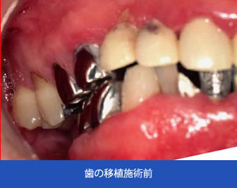 歯の移植施術前
