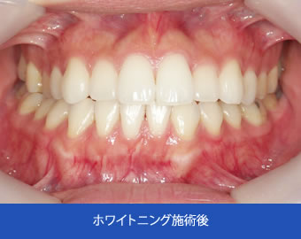 インプラント施術後