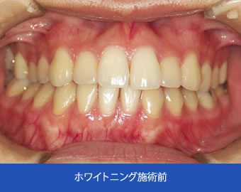 ホワイトニング施術前