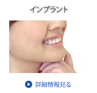 インプラント